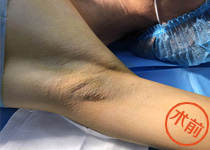 美国水刀技术,领航腋臭诊疗新趋势_济南军颐腋臭研究院